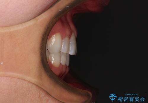 矯正治療の後戻り インビザライン・ライトでの再矯正の治療後