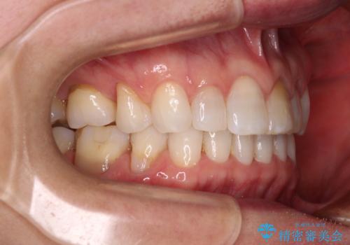 矯正治療の後戻り インビザライン・ライトでの再矯正の治療後