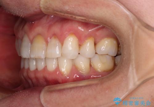 矯正治療の後戻り インビザライン・ライトでの再矯正の治療後