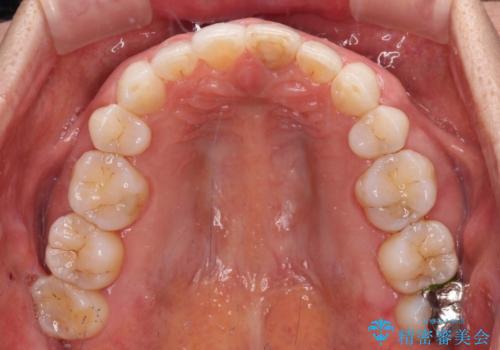 矯正治療の後戻り インビザライン・ライトでの再矯正の治療後