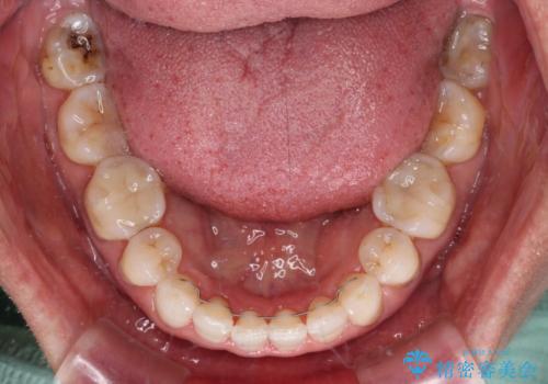 矯正治療の後戻り インビザライン・ライトでの再矯正の治療後