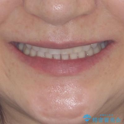 矯正治療の後戻り インビザライン・ライトでの再矯正の治療後(顔貌)