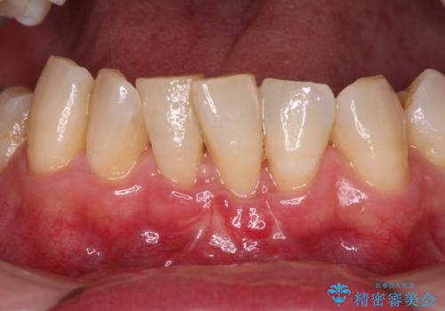 歯根が見えてしみる　歯肉移植による歯肉退縮の改善の治療後