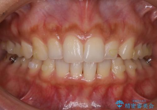 【非抜歯】狭い歯列を改善 ガタつきを治すの治療中
