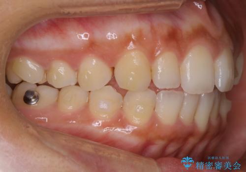 【非抜歯】狭い歯列を改善 ガタつきを治すの治療中
