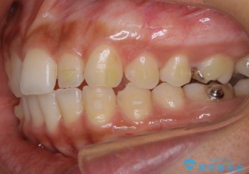 【非抜歯】狭い歯列を改善 ガタつきを治すの治療中