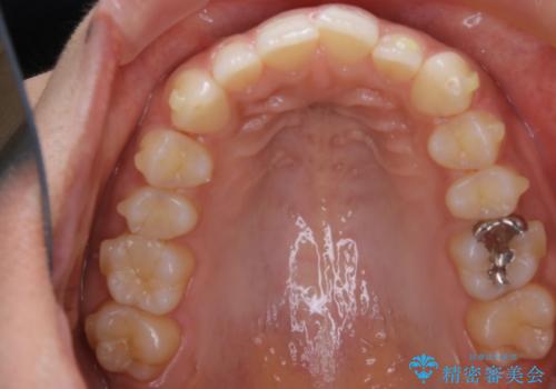 【非抜歯】狭い歯列を改善 ガタつきを治すの治療中