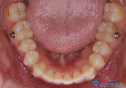 【非抜歯】狭い歯列を改善 ガタつきを治すの治療中