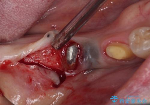 治療後に歯茎から出血 インプラントとオールセラミッククラウンの補綴治療の治療前