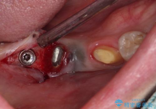 治療後に歯茎から出血 インプラントとオールセラミッククラウンの補綴治療の治療中