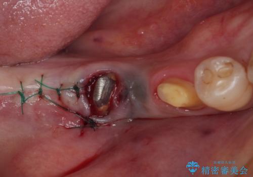 治療後に歯茎から出血 インプラントとオールセラミッククラウンの補綴治療の治療後