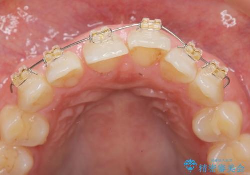 前歯のガタつきをきれいに マウスピース矯正治療の治療前