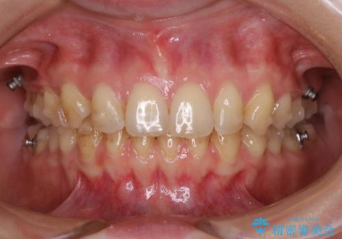 マウスピースをしたままコーヒーを飲むと着色がすごい