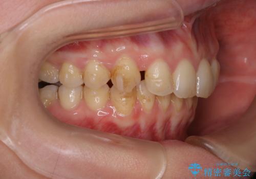 マウスピースをしたままコーヒーを飲むと着色がすごいの治療前