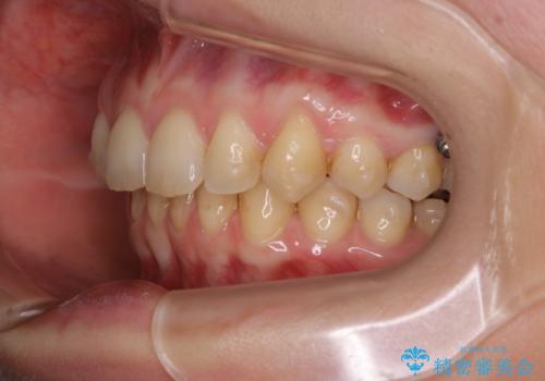 マウスピースをしたままコーヒーを飲むと着色がすごいの治療前