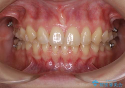 マウスピースをしたままコーヒーを飲むと着色がすごいの症例 治療後