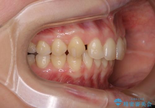 マウスピースをしたままコーヒーを飲むと着色がすごいの治療後