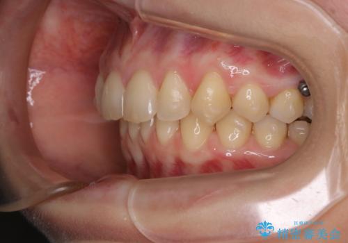 マウスピースをしたままコーヒーを飲むと着色がすごいの治療後