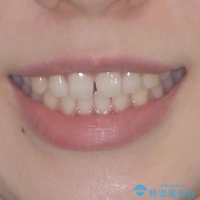 すきっ歯とオープンバイト　インビザライン・ライトで改善の治療前（顔貌）