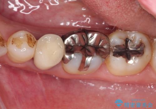 銀歯を白くしたい セラミックによる審美歯科治療の治療前