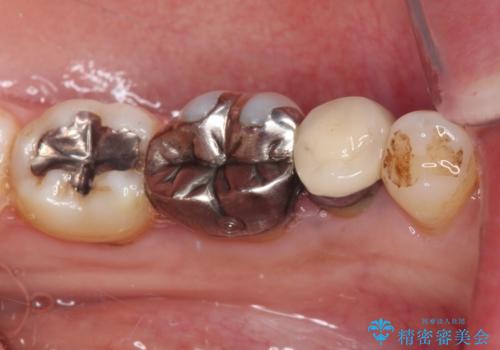 銀歯を白くしたい セラミックによる審美歯科治療の治療前