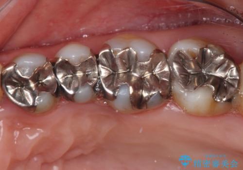 銀歯を白くしたい セラミックによる審美歯科治療の治療前