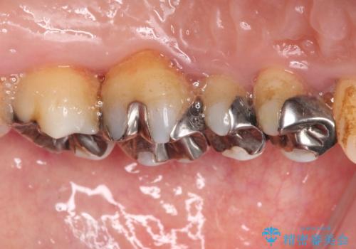 銀歯を白くしたい セラミックによる審美歯科治療の治療前