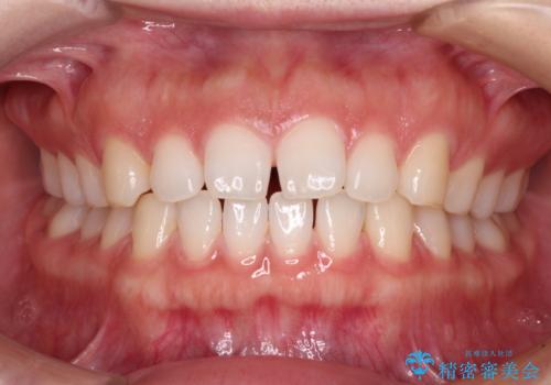 すきっ歯とオープンバイト　インビザライン・ライトで改善の症例 治療前