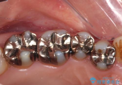 銀歯を白くしたい セラミックによる審美歯科治療の治療前