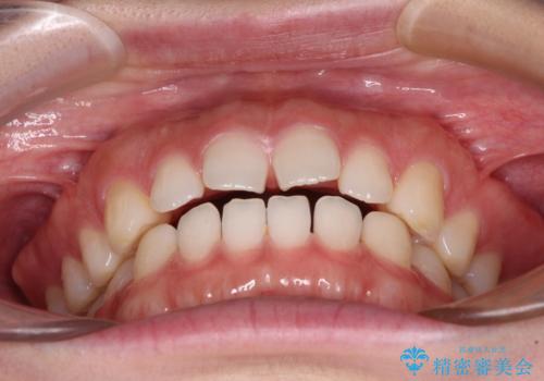 すきっ歯とオープンバイト インビザライン・ライトで改善の治療前