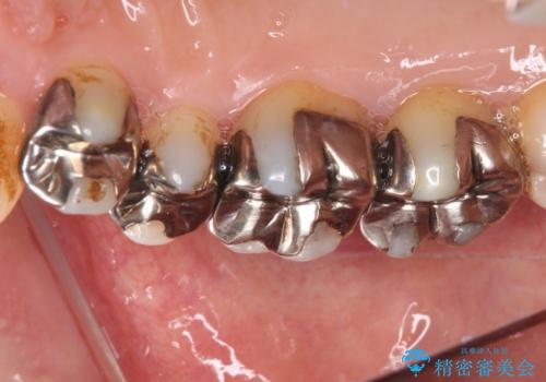 銀歯を白くしたい セラミックによる審美歯科治療の治療前