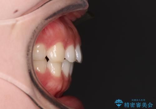 すきっ歯とオープンバイト インビザライン・ライトで改善の治療前