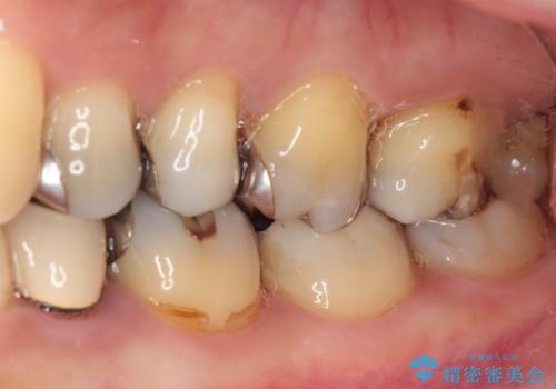 銀歯を白くしたい セラミックによる審美歯科治療の治療前