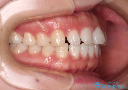 すきっ歯とオープンバイト インビザライン・ライトで改善の治療前