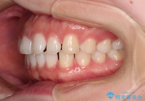 すきっ歯とオープンバイト インビザライン・ライトで改善の治療前