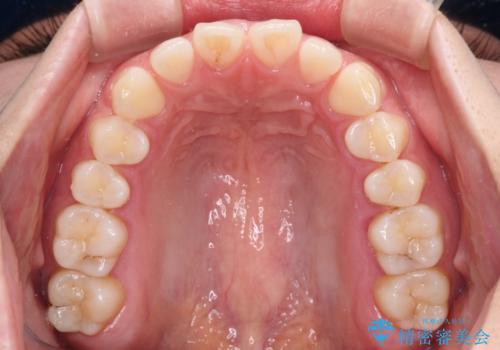 すきっ歯とオープンバイト　インビザライン・ライトで改善の治療前