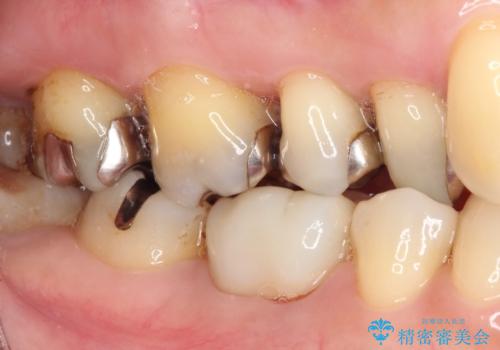 銀歯を白くしたい セラミックによる審美歯科治療の治療前