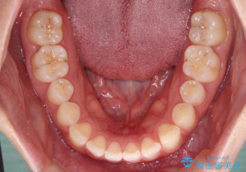 すきっ歯とオープンバイト インビザライン・ライトで改善の治療前