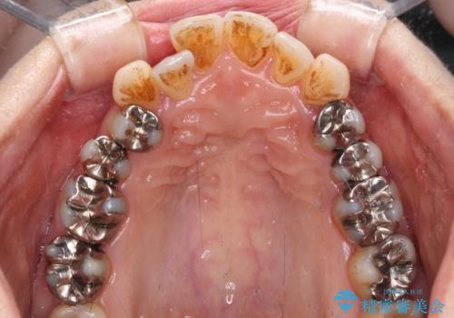 銀歯を白くしたい セラミックによる審美歯科治療の治療前