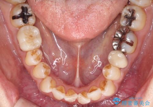 銀歯を白くしたい セラミックによる審美歯科治療の治療前