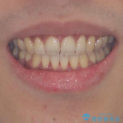 隙間が空いて突出した前歯を治した　ワイヤー装置による抜歯矯正の治療後（顔貌）