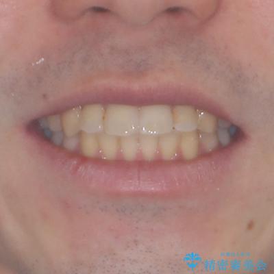 前歯のデコボコを治したい　ワイヤー装置でお手軽に矯正治療の治療後（顔貌）