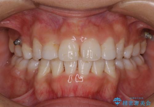 インビザラインのマウスピース発注待ち時、クリーニングおすすめの治療前