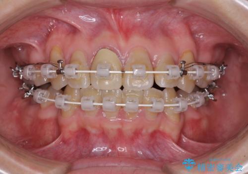 八重歯とクロスバイト　目立たないワイヤー装置での抜歯矯正の治療中
