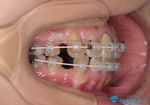 八重歯とクロスバイト　目立たないワイヤー装置での抜歯矯正の治療中