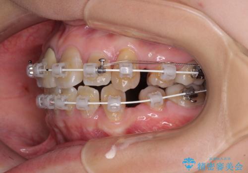 八重歯とクロスバイト 目立たないワイヤー装置での抜歯矯正の治療中