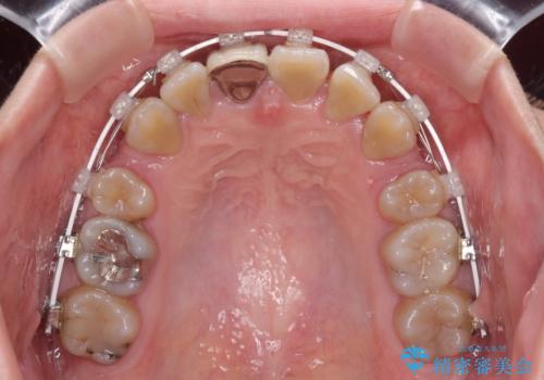 八重歯とクロスバイト 目立たないワイヤー装置での抜歯矯正の治療中