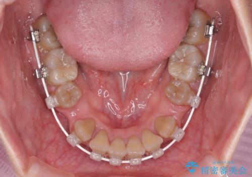 八重歯とクロスバイト 目立たないワイヤー装置での抜歯矯正の治療中