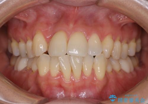 矯正スタート前のクリーニング(PMTC)