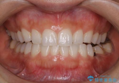 お口の中全体にプラーク(歯垢)が付着している方のクリーニンングの治療前
